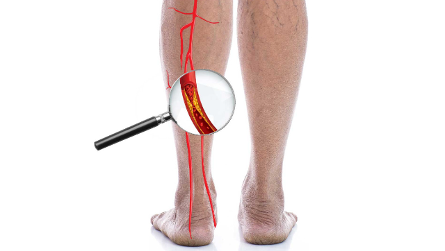 Mengenal Pengobatan Penyakit Arteri Perifer