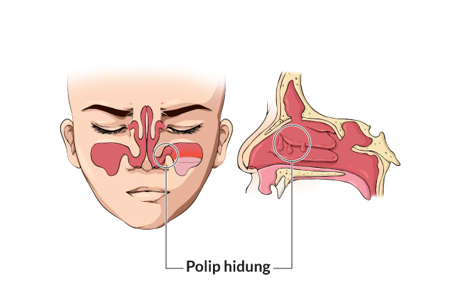 4 Tips Melakukan Perawatan Pada Polip Hidung Anak